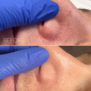 Before and after blemish removal at Helena Aesthetics Middlesbrough